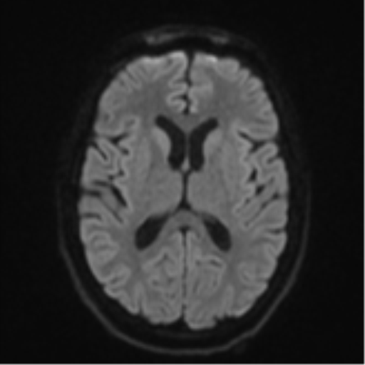 Cerebellar metastasis - adenocarcinoma lung (Radiopaedia 63184-71715 Axial DWI 45).png