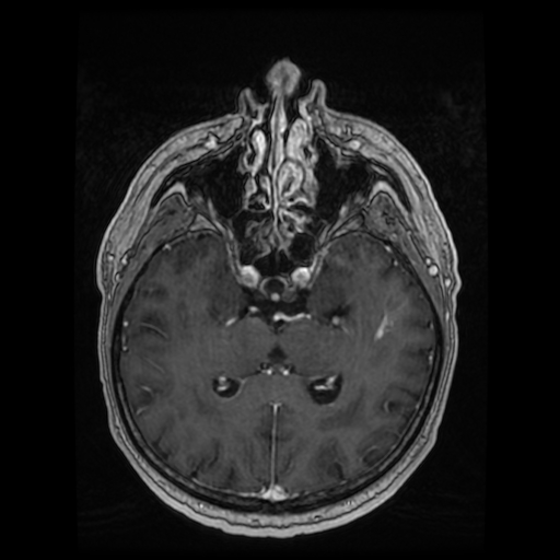 Cerebellar metastasis of pulmonary adenocarcinoma, cavernous venous malformation, and developmental venous anomaly (Radiopaedia 85827-101661 Axial T1 C+ 47).jpg