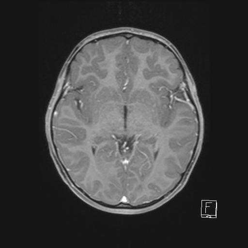 Cerebellar stroke (Radiopaedia 32202-33150 Axial T1 C+ 38).png