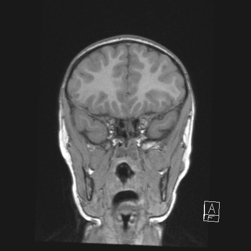 Cerebellar stroke (Radiopaedia 32202-33150 Coronal T1 17).png