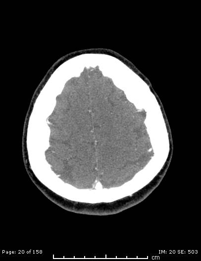 Cerebellar strokes due to intracranial giant cell arteritis (Radiopaedia 68799-78510 CT angiogram 20).jpg