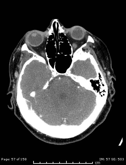 Cerebellar strokes due to intracranial giant cell arteritis (Radiopaedia 68799-78510 CT angiogram 57).jpg