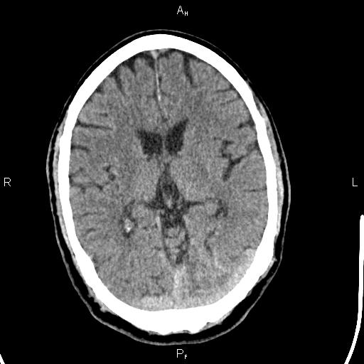 File:Cerebellopontine angle arachnoid cyst (Radiopaedia 85149-100704 Axial With contrast 26).jpg