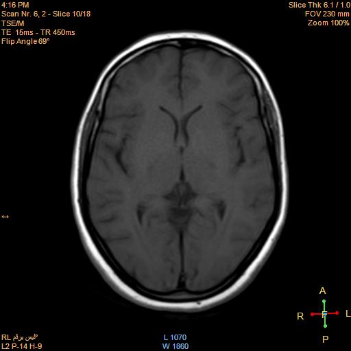 File:Cerebellopontine angle meningioma (Radiopaedia 22488-22525 Axial T1 9).jpg