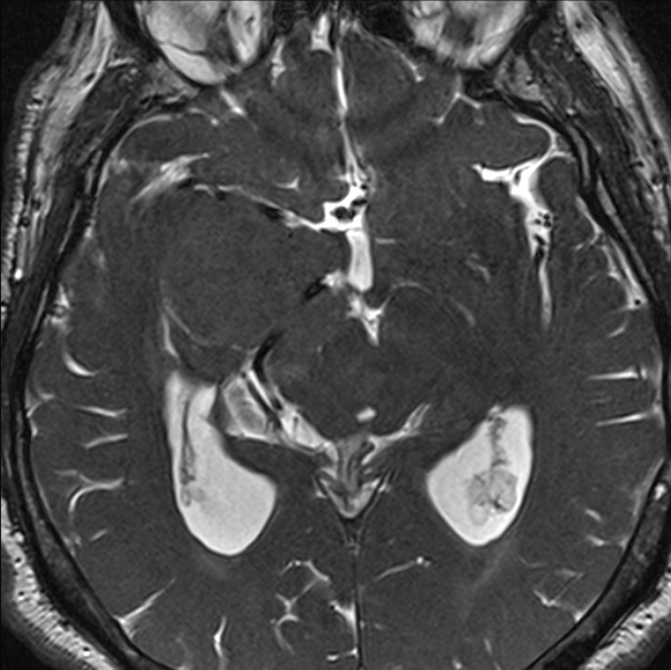 Cerebellopontine angle meningioma (Radiopaedia 24459-24764 I 47).jpg