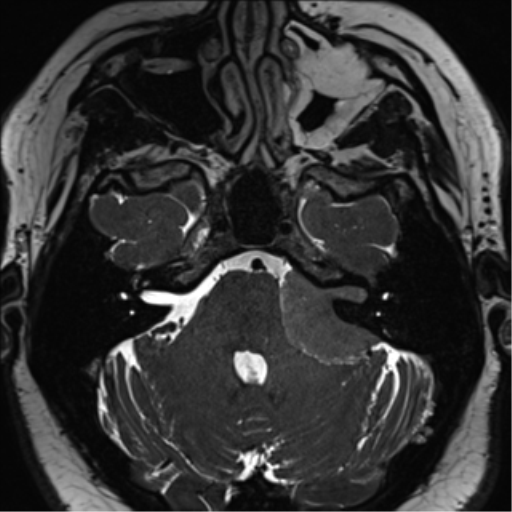 Cerebellopontine angle meningioma (Radiopaedia 48434-53348 Axial T2 Space 59).png