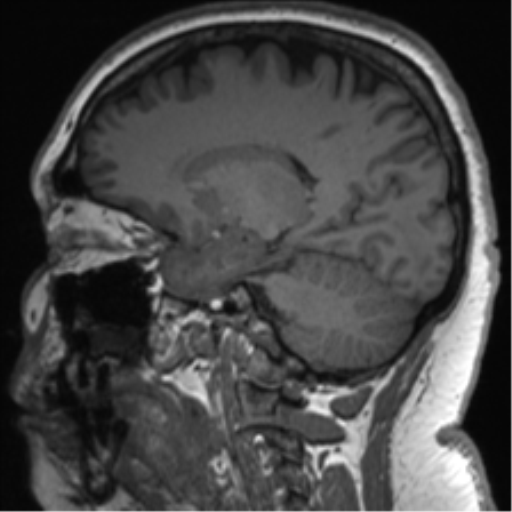 Cerebellopontine angle meningioma (Radiopaedia 48434-53348 Sagittal T1 56).png