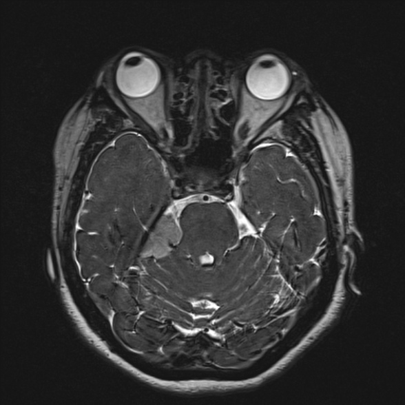 Cerebellopontine angle meningioma (Radiopaedia 53561-59591 Axial 3D volume T2 77).jpg