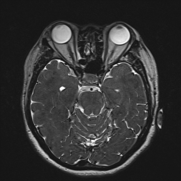 Cerebellopontine angle meningioma (Radiopaedia 53561-59591 Axial 3D volume T2 87).jpg