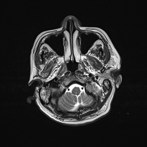 Cerebral abscess (Radiopaedia 26111-26247 Axial T2 12).jpg