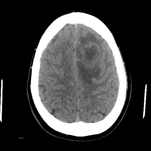Cerebral abscess (Radiopaedia 29451-29919 Axial non-contrast 39).jpg