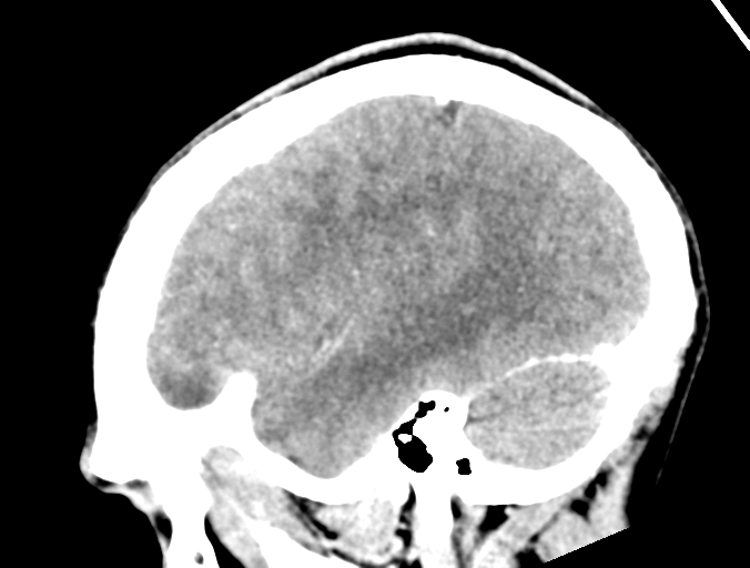 Cerebral abscess (Radiopaedia 60342-68008 Sagittal C+ delayed 12).png