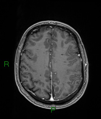Cerebral abscess and subdural empyema (Radiopaedia 84436-99779 Axial T1 C+ 28).jpg