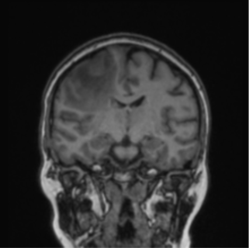 Cerebral abscess from pulmonary arteriovenous malformation (Radiopaedia 86275-102291 Coronal T1 48).png