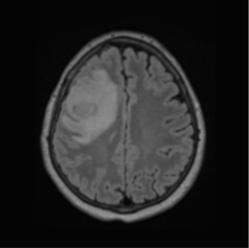 Cerebral abscess from pulmonary arteriovenous malformation (Radiopaedia 86275-102291 J 53).png