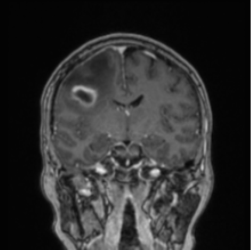 Cerebral abscess from pulmonary arteriovenous malformation (Radiopaedia 86275-102291 L 48).png