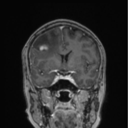 Cerebral abscess from pulmonary arteriovenous malformation (Radiopaedia 86275-102291 L 55).png