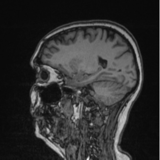 Cerebral abscess from pulmonary arteriovenous malformation (Radiopaedia 86275-102291 Sagittal T1 42).png