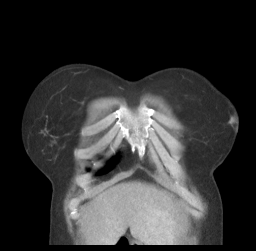 Cerebral abscess from pulmonary arteriovenous malformation (Radiopaedia 86275-102292 C 10).png