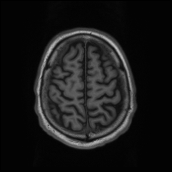 File:Cerebral abscess with ventriculitis (Radiopaedia 78965-91878 Axial T1 41).jpg
