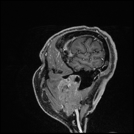 Cerebral abscess with ventriculitis (Radiopaedia 78965-91878 Sagittal T1 C+ 159).jpg