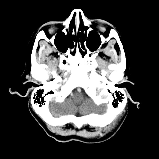 File:Cerebral amyloid angiopathy-related inflammation (Radiopaedia 74836-85848 Axial non-contrast 11).jpg