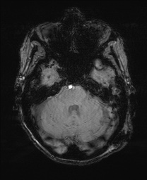 Cerebral amyloid angiopathy-related inflammation (Radiopaedia 74836-85849 Axial SWI 20).jpg