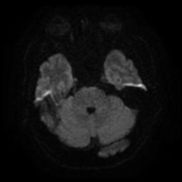 Cerebral amyloid angiopathy (Radiopaedia 28698-28978 Axial DWI 8).jpg