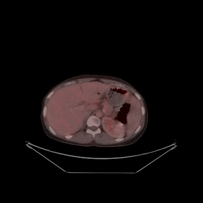 Cerebral and abdominal tuberculosis (Radiopaedia 90499-107853 C 142).jpg
