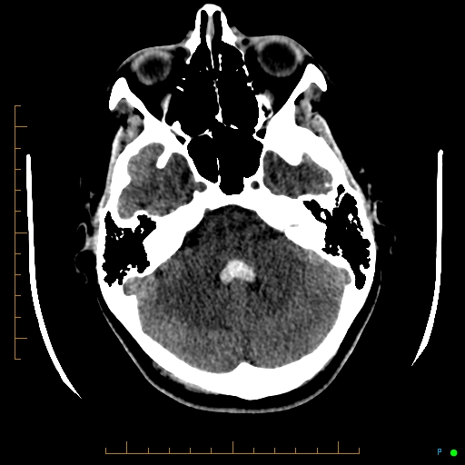 File:Cerebral arteriovenous malformation (AVM) (Radiopaedia 78162-90706 Axial non-contrast 18).jpg