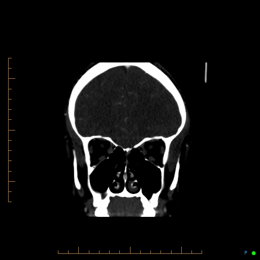 Cerebral arteriovenous malformation (AVM) (Radiopaedia 78162-90706 Coronal CTA 78).jpg