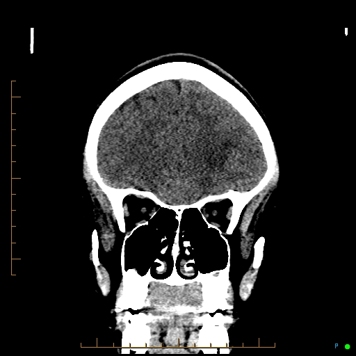 Cerebral arteriovenous malformation (AVM) (Radiopaedia 78162-90706 Coronal non-contrast 27).jpg