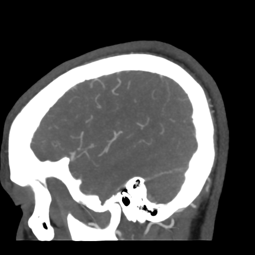 Cerebral arteriovenous malformation (Radiopaedia 39259-41505 Sagittal 13).png