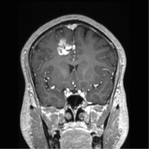 Cerebral arteriovenous malformation (Radiopaedia 39259-41506 Coronal T1 C+ 60).png