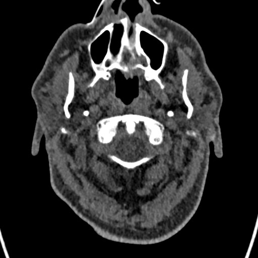Cerebral arteriovenous malformation (Radiopaedia 78188-90746 Axial non-contrast 6).jpg