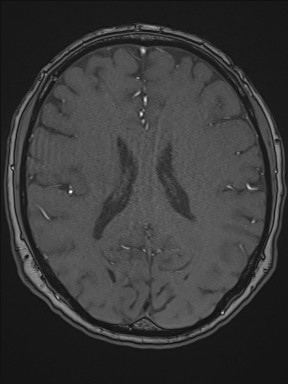 File:Cerebral arteriovenous malformation (Radiopaedia 84015-99245 Axial TOF 146).jpg