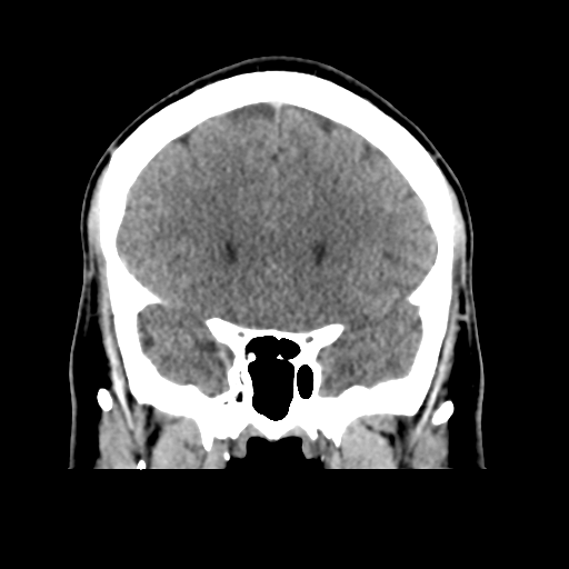 Cerebral arteriovenous malformation (Spetzler-Martin grade 2) (Radiopaedia 41262-44076 Coronal non-contrast 21).png