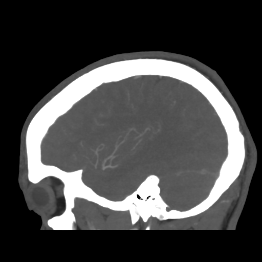 Cerebral arteriovenous malformation (Spetzler-Martin grade 2) (Radiopaedia 41262-44076 G 41).png