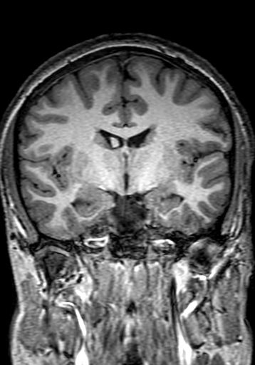 Cerebral arteriovenous malformation at posterior body of corpus callosum (Radiopaedia 74111-84925 Coronal T1 153).jpg