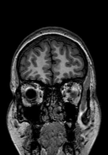 Cerebral arteriovenous malformation at posterior body of corpus callosum (Radiopaedia 74111-84925 Coronal T1 30).jpg