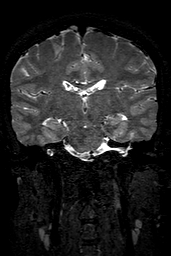 Cerebral arteriovenous malformation at posterior body of corpus callosum (Radiopaedia 74111-84925 Coronal T2 98).jpg