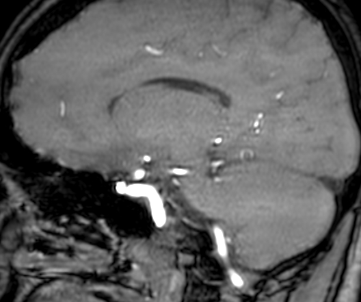 Cerebral arteriovenous malformation at posterior body of corpus callosum (Radiopaedia 74111-84925 J 234).jpg