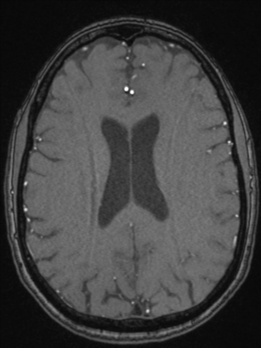 Cerebral arteriovenous malformation with hemorrhage (Radiopaedia 34422-35737 Axial MRA 53).png