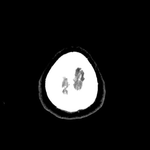 Cerebral arteriovenous malformation with lobar hemorrhage (Radiopaedia 35598-57216 A 60).jpg