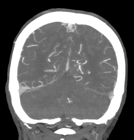 Cerebral arteriovenous malformation with lobar hemorrhage (Radiopaedia 44725-48511 B 44).png