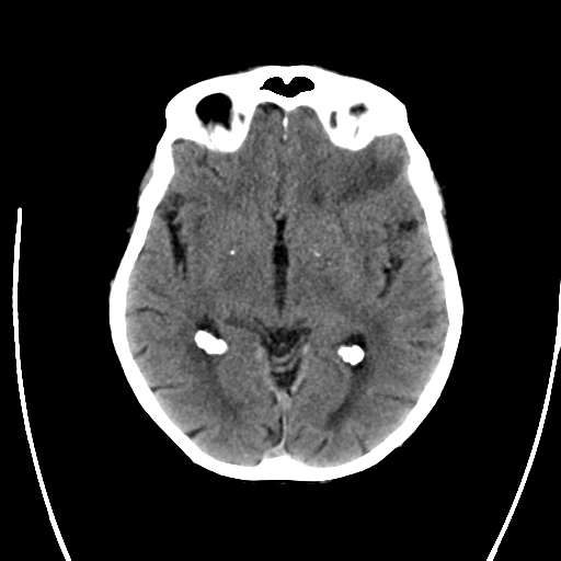 File:Cerebral arteriovenous malformation with lobar hemorrhage (Radiopaedia 44725-48512 Axial non-contrast 18).png