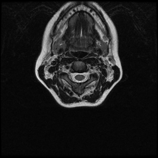 Cerebral autosomal dominant arteriopathy with subcortical infarcts and leukoencephalopathy (CADASIL) (Radiopaedia 41018-43763 Ax T2 C2-T1 32).png