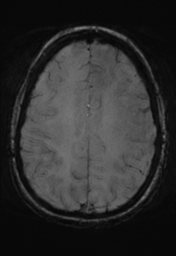 File:Cerebral cavernoma and development venous anomaly (Radiopaedia 37603-39482 Axial SWI 28).png
