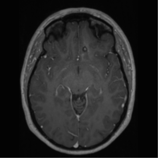 Cerebral cavernoma and development venous anomaly (Radiopaedia 37603-39482 Axial T1 C+ 34).png