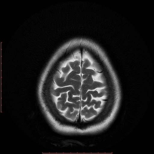 File:Cerebral cavernous malformation (Radiopaedia 26177-26306 Axial T2 19).jpg